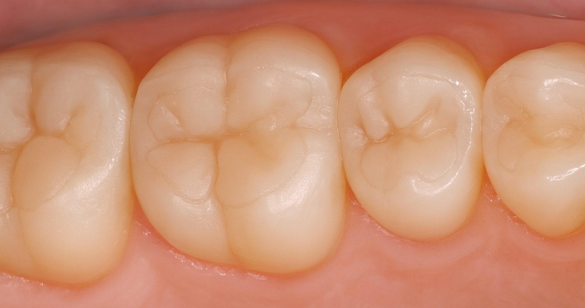 Close-up of three molar teeth in the upper jaw, showing smooth, healthy enamel surfaces and a pink gum line.