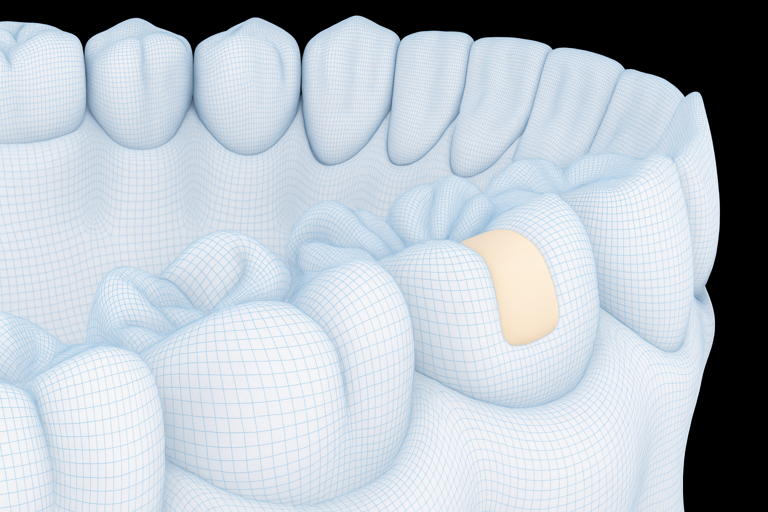 Biomimetic white dental filling designed to restore tooth structure while preserving natural strength and function
