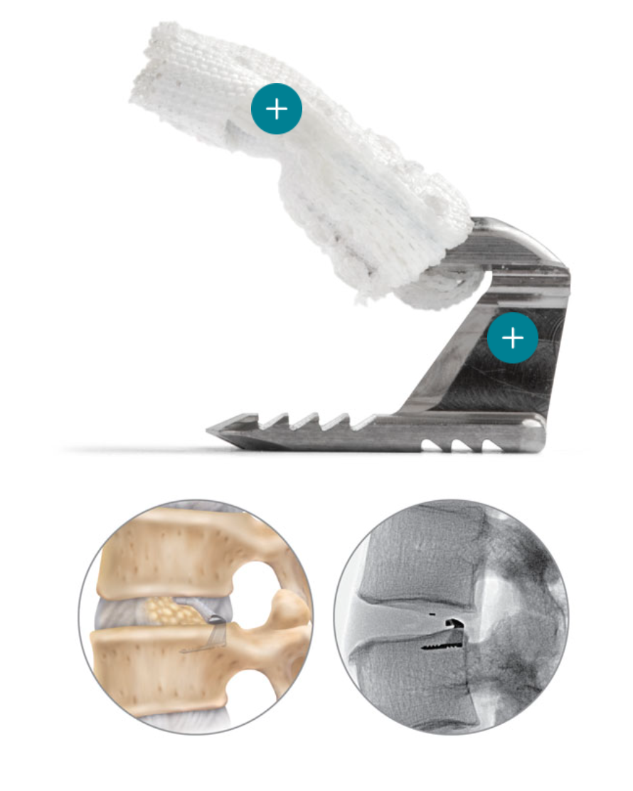 Dr. NaPier offers Barricaid Annular Closure Device to Reduce Risk of Recurrent Disc Herniation and Sciatica