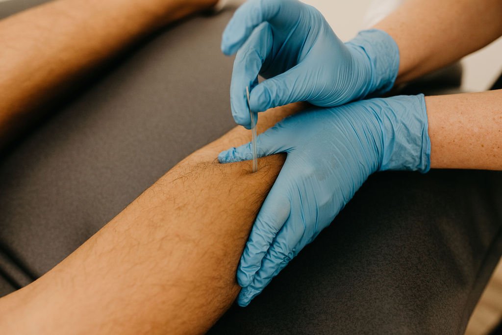 Grindstone Physiotherapy Waterdown Integrated Dry Needling and Acupuncture