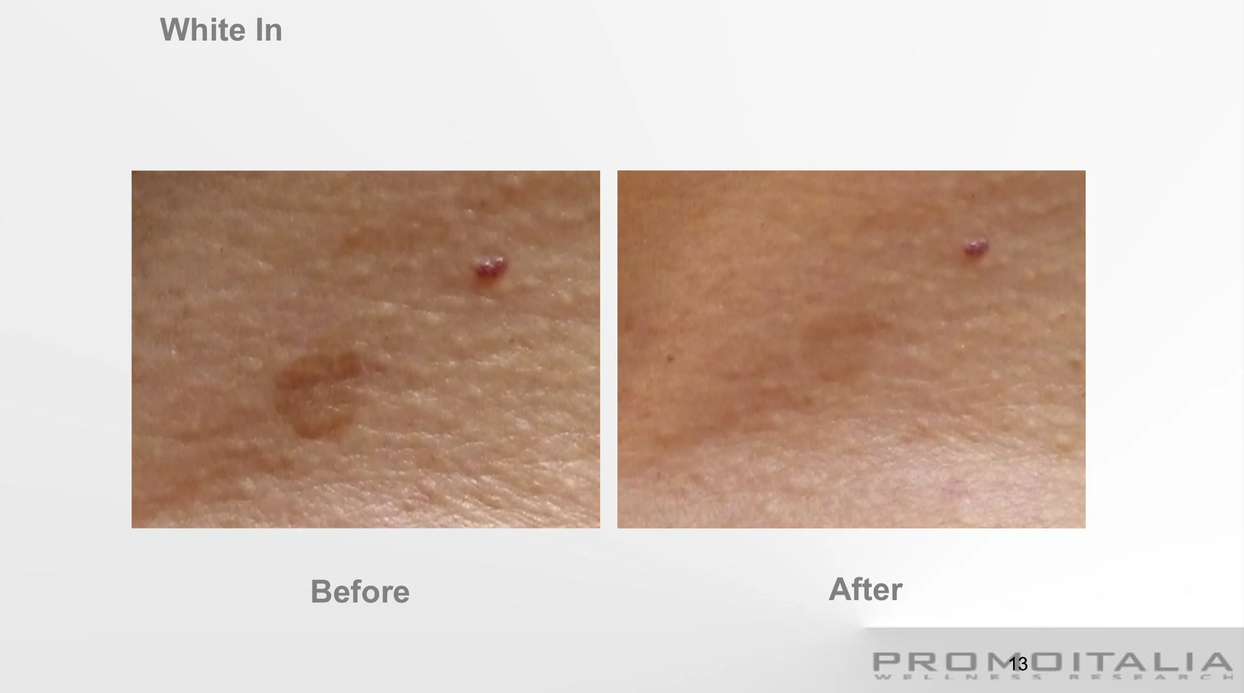 Skin Hyperpigmentaion