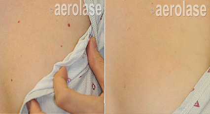 Angiomas - Pair.png