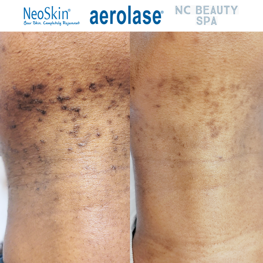 "Achieve Clear, Radiant Skin with Aerolase NeoClear: The Ultimate Acne Treatment"