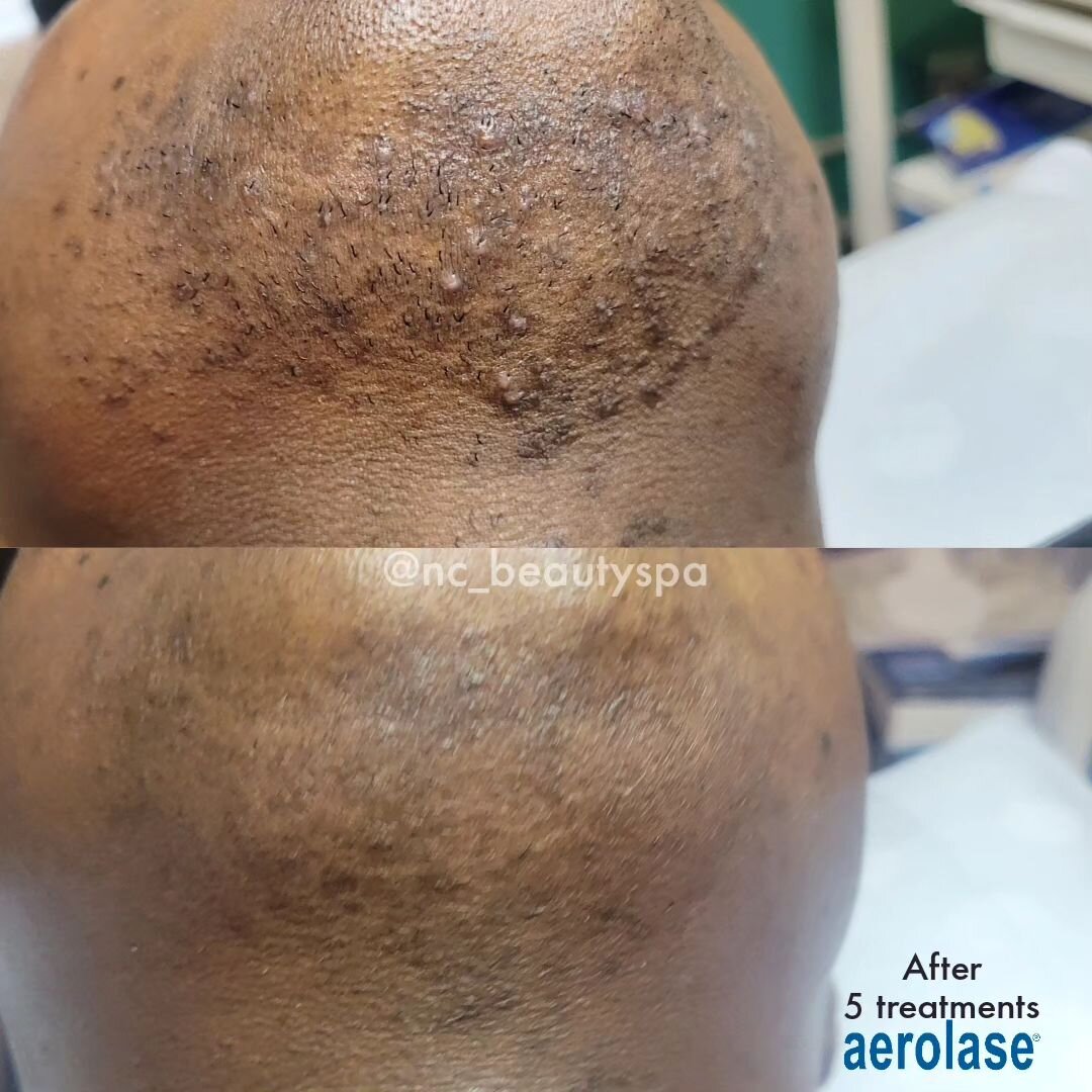🎯 5 weeks after 5th Session of Aerolase Neo for unwanted &amp; severe ingrown hairs.

⚡️High-powered laser energy targets melanin, water and blood/vessels. 

✅️Reduces hair permanently 
✅️Lightens Dark Spots
✅️Alleviates inflammation 
✅️Stimulates c