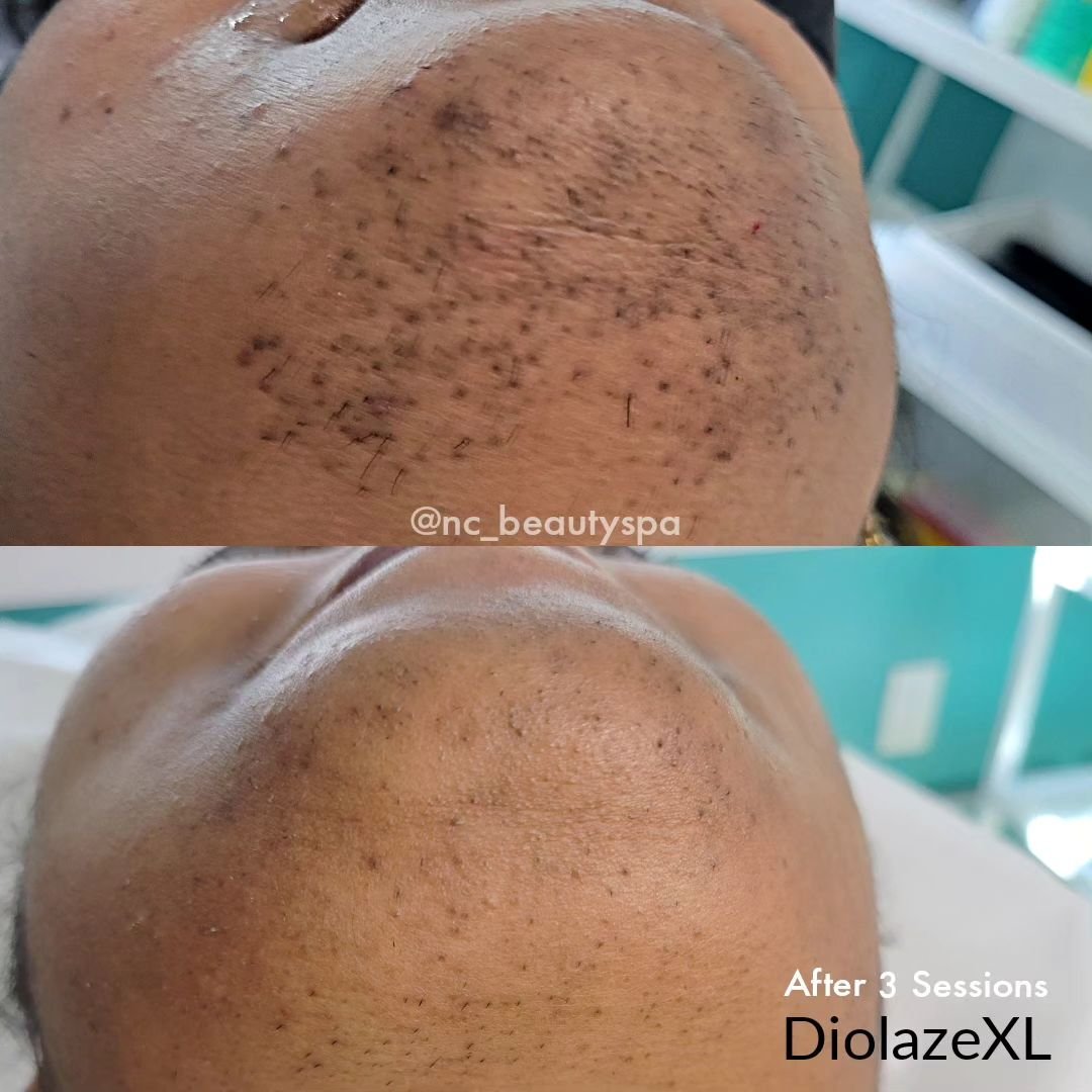 ⚠️2 years after 3 sessions of DiolazeXL 
The client stopped her laser sessions and continued with waxing &amp; shaving for 2 years.

See how effective our DiolazeXL Laser. Even though the client stopped and did not finish the required number of treat