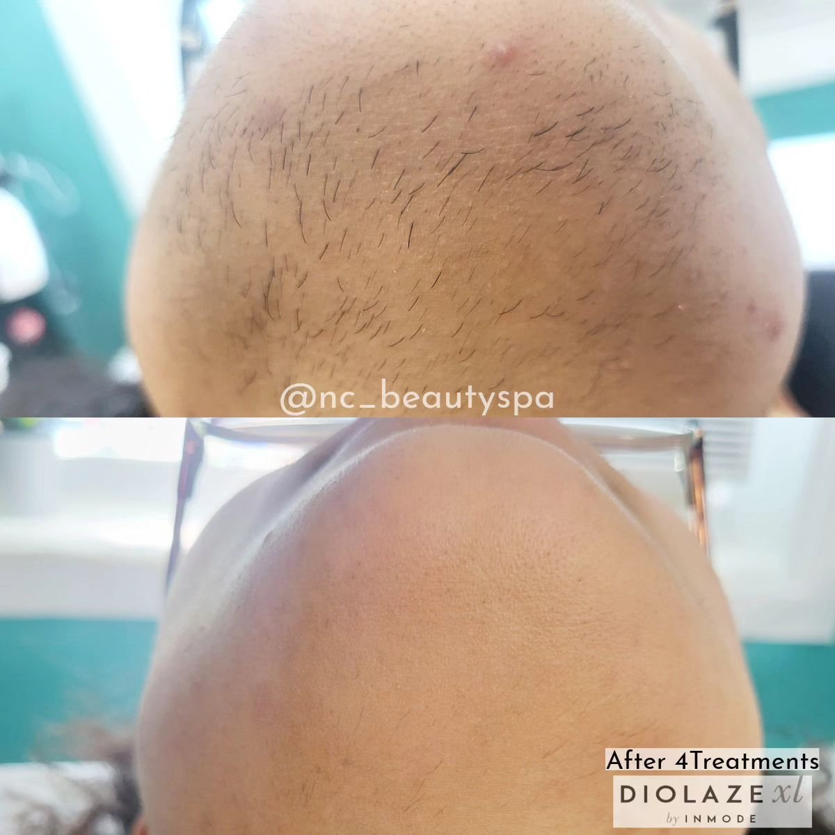 😍One Happy Client

Want to get rid our your unwanted hair? 
Talk to us about DiolazeXL Laser  Hair Removal 

📲Call/Text us at 416-562-8303 
📍3068B Hurontario St Mississauga ON 

#DiolazeXLByInmode #lasertreatment #DiolazeXL #unwantedHair #laserhai