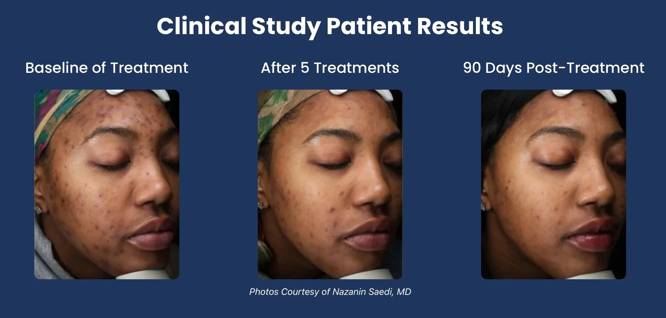 Achieve Clear Skin with Aerolase NeoClear in Mississauga and the GTA