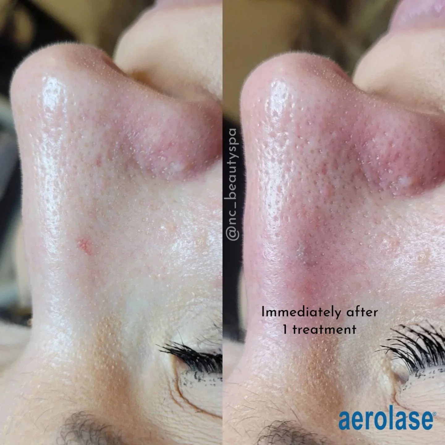 Say goodbye to red, flushed skin and spider veins! 👋
Aerolase Neo Elite uses advanced laser technology to target and eliminate unwanted vascular lesions. This non-invasive treatment offers a quick and effective solution for:
✅️ Rosacea
✅️ Facial r