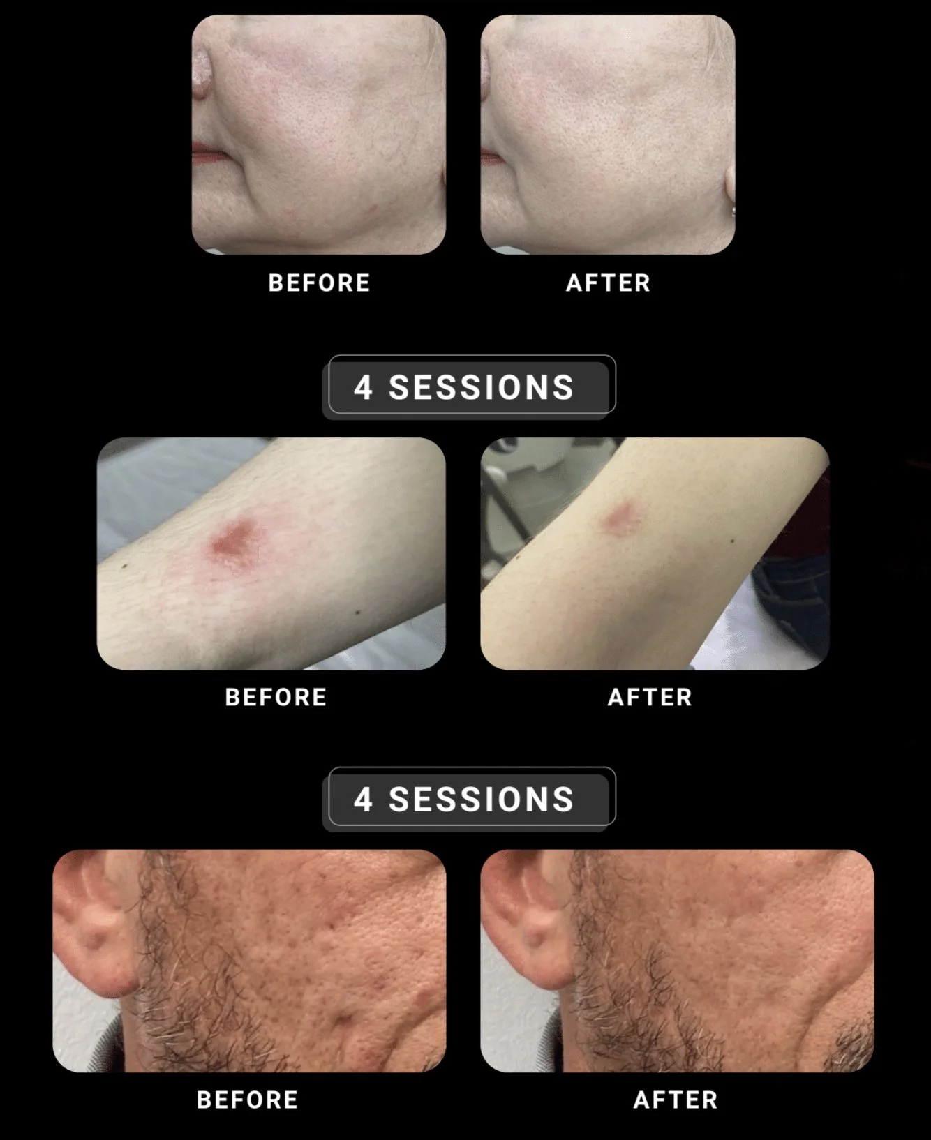 V-Tech system with synthetic Exosomes before and after photos