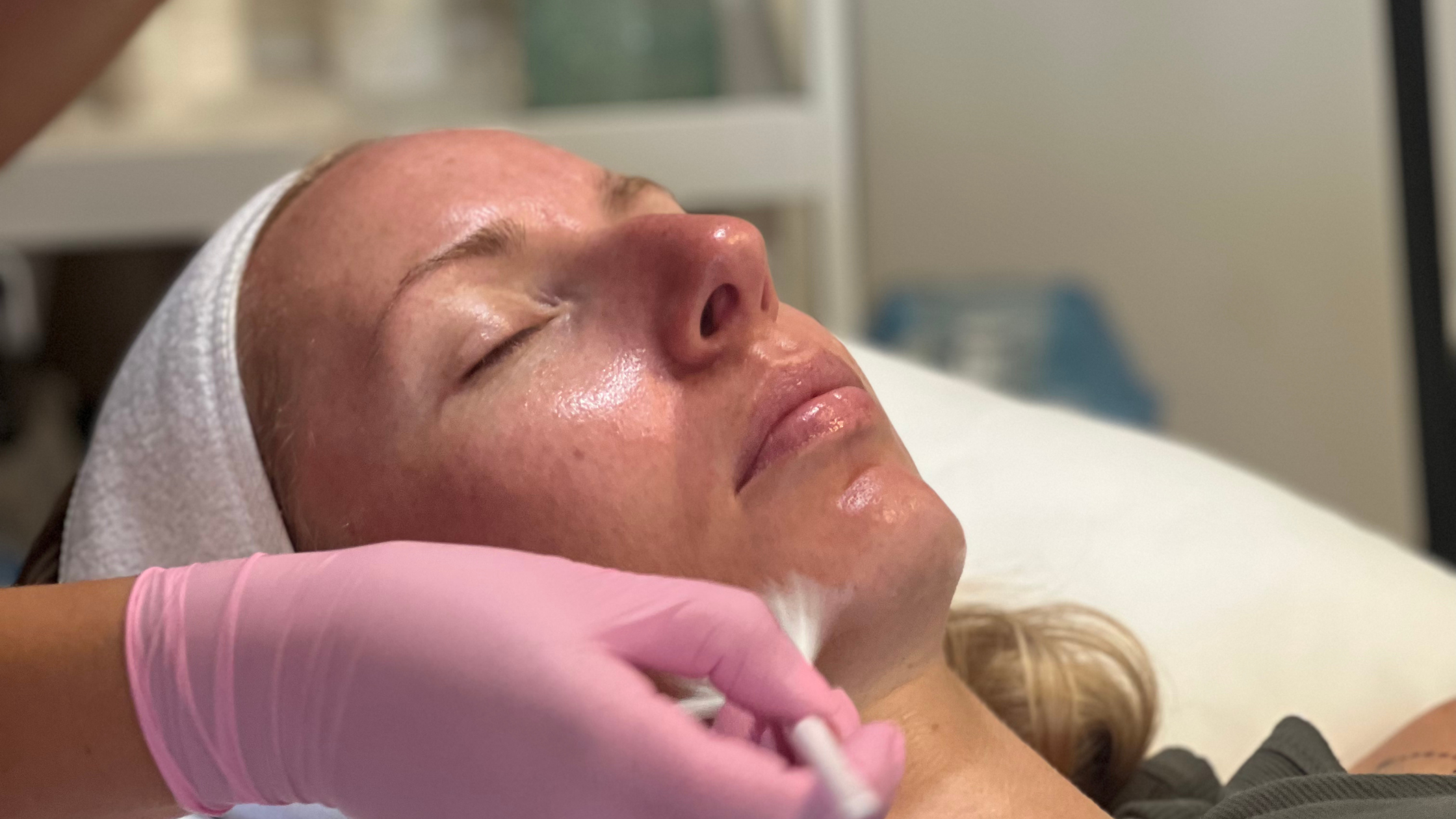 Chemical Peels at Vena Health + Wellness