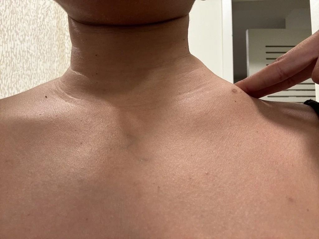 The lump that started it all.