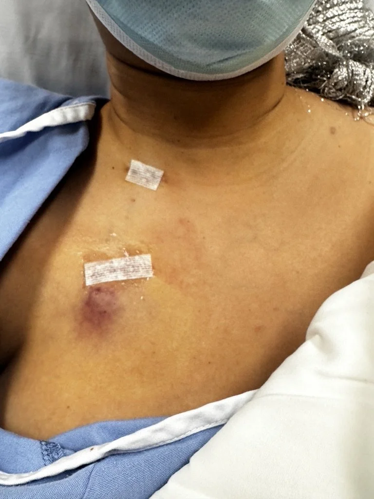 Surgery: Port Placement