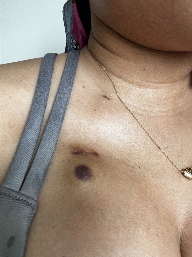 Bruising as a result of chemo