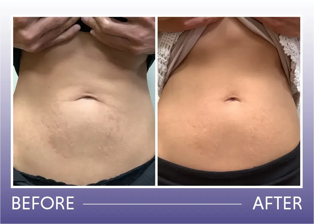 Before and after neo laser treatment for stretch marks and skin toning result