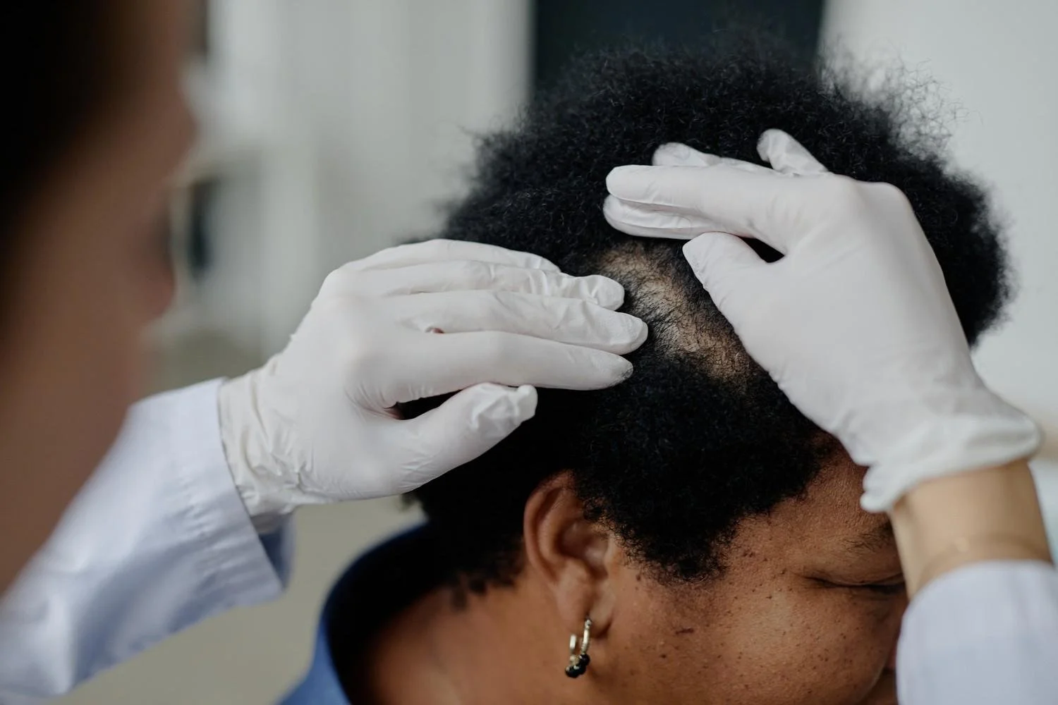Hair Loss Treatment in Wisconsin: Why a Dermatologist Should Be the First Step
