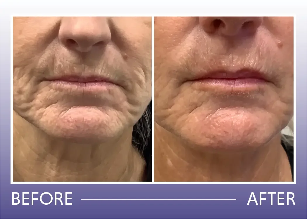 Before and after filler treatment result