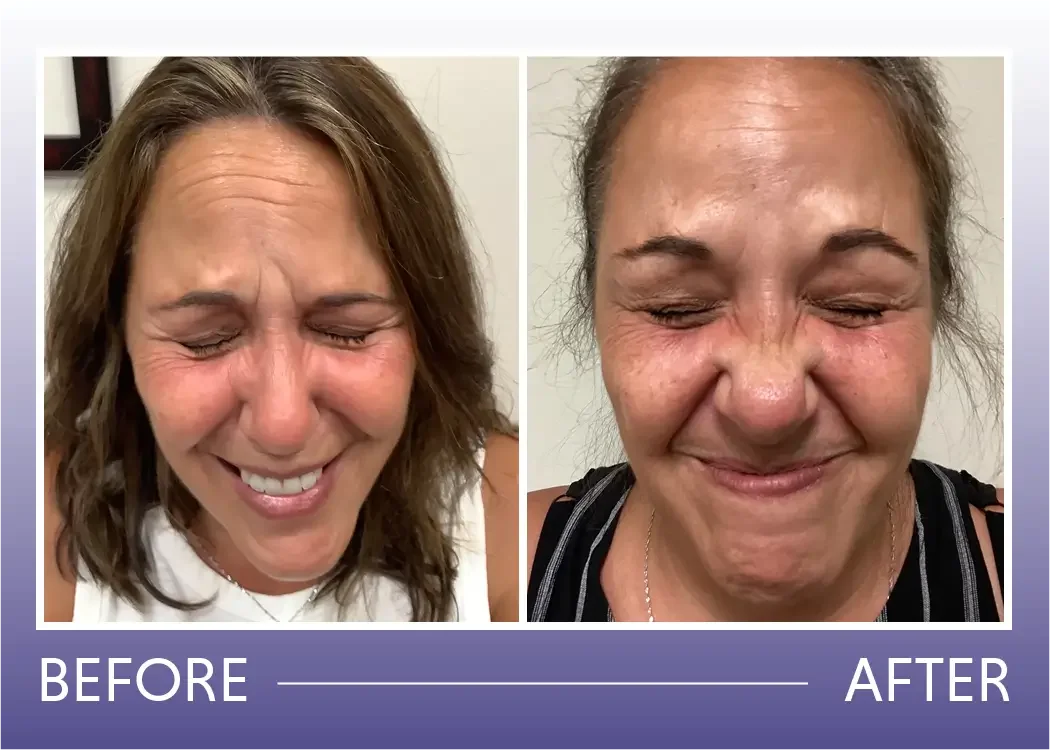 Before and after Botox treatment result