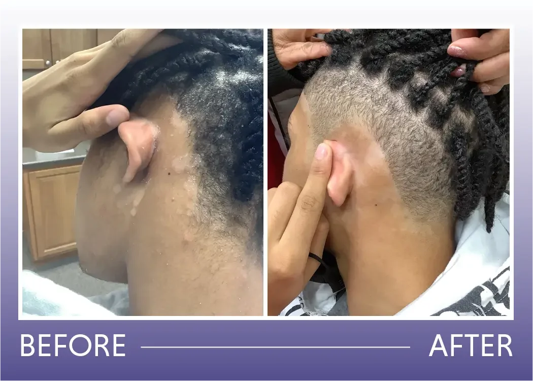 Before and after dandruff and seborrheic dermatitis result