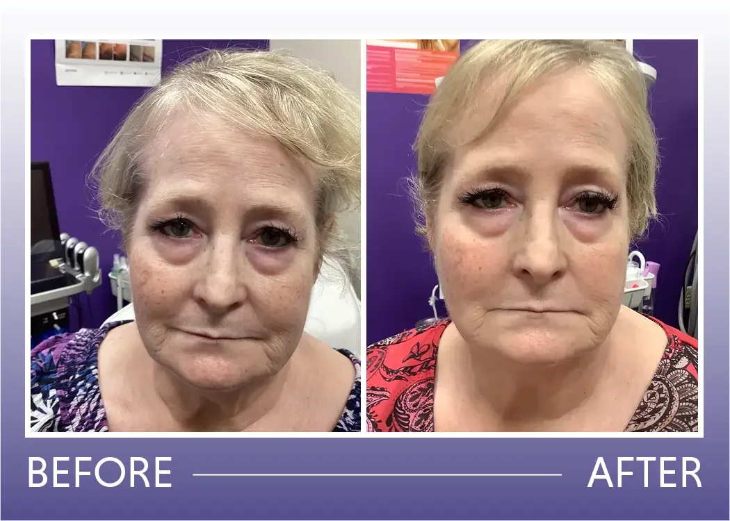 Before and after Botox treatment result