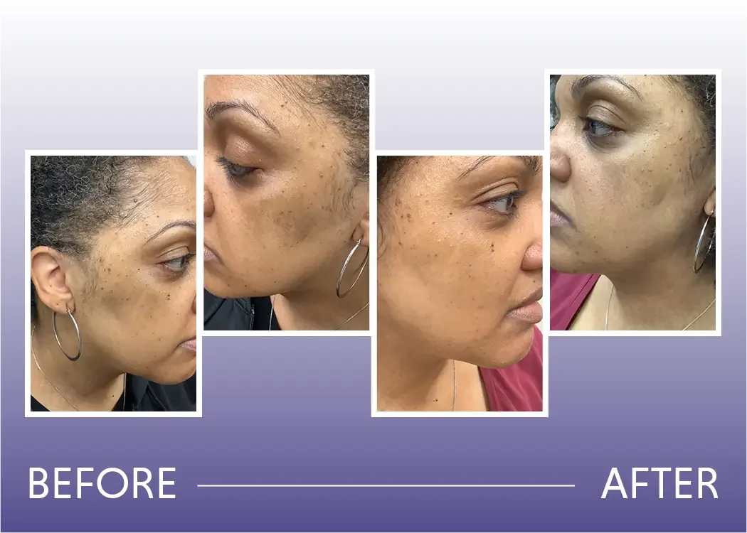 Before and after result of melasma treated with neo laser