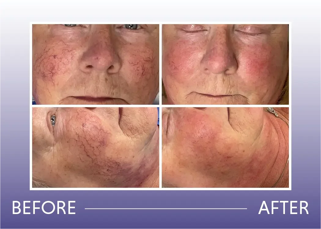 Before and after rosacea laser treatment result