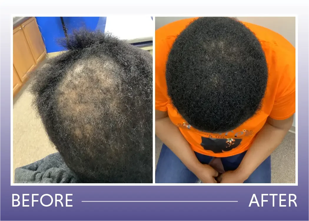 Before and after scarring hair loss with steroid injections, oral antibiotics, and steroid topical result