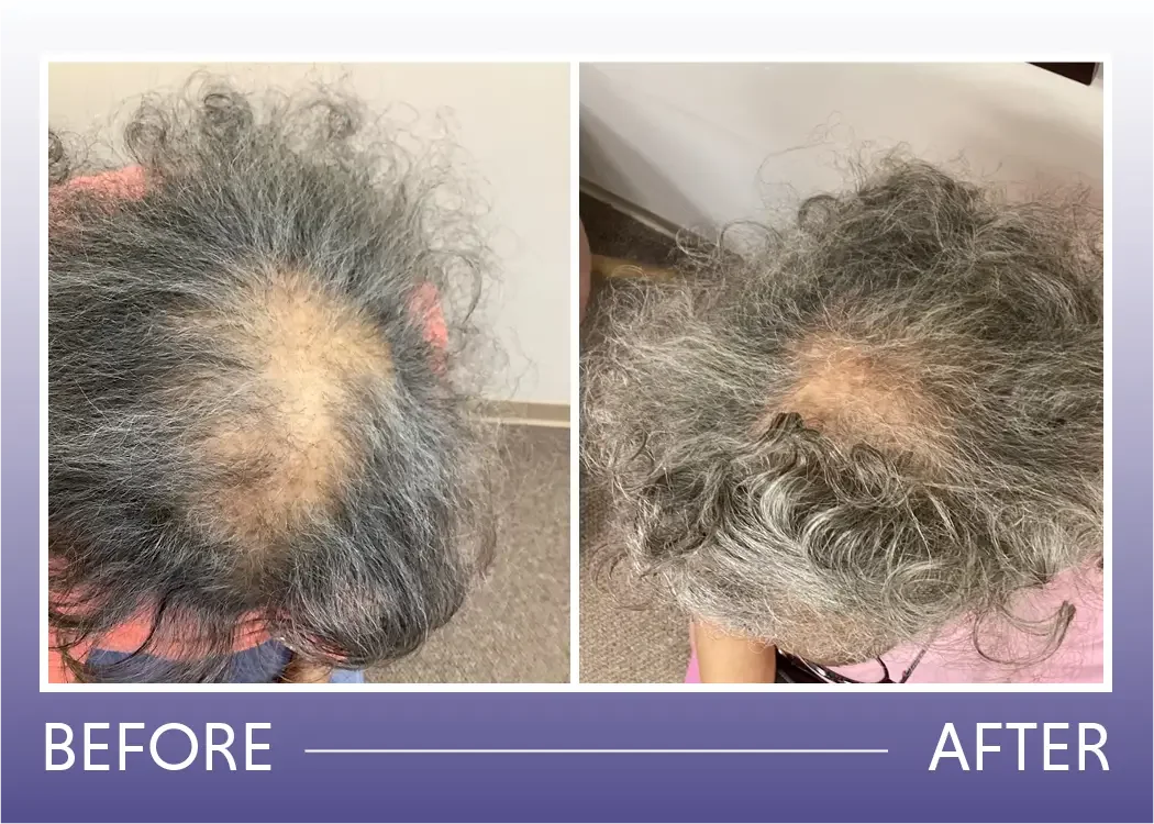 Before and after hair loss treatment result