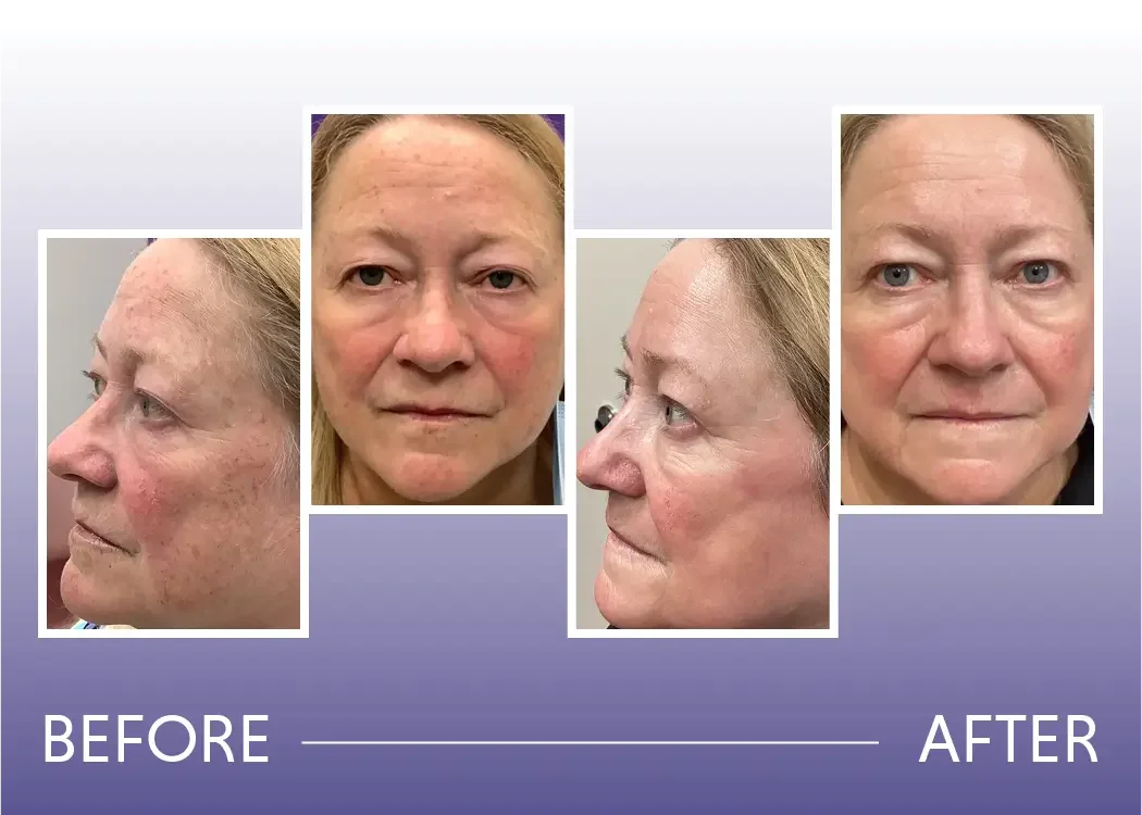 Before and after chemical peel for sun spots treatment result