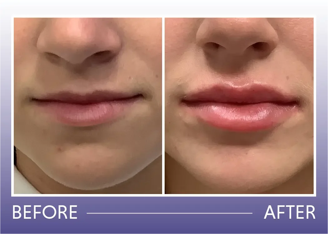 Before and after lip fillers treatment result
