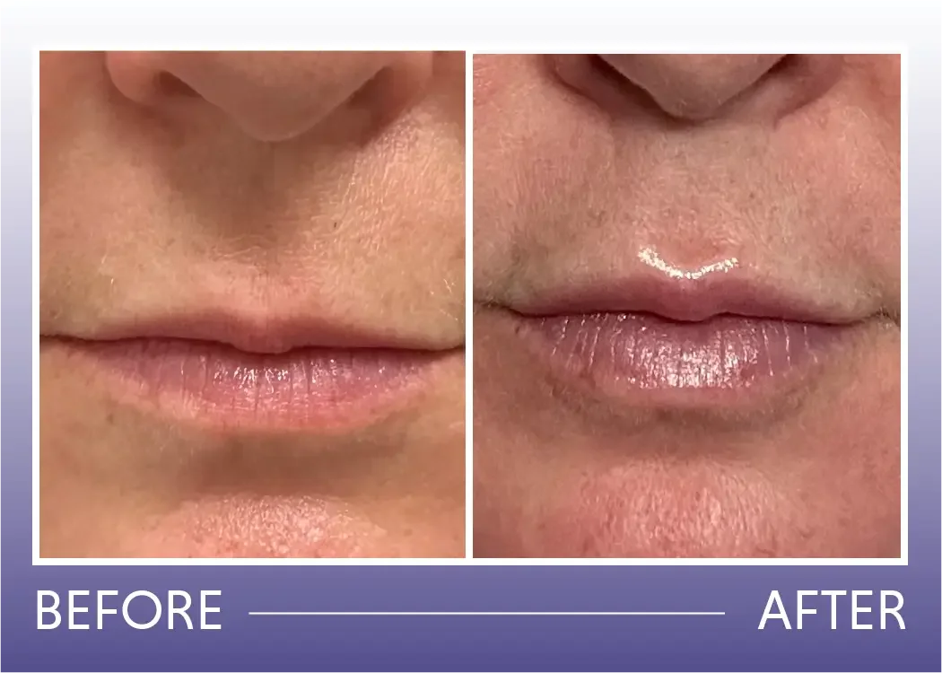 Before and after lip fillers treatment result