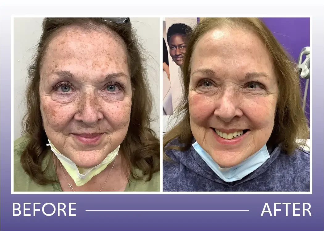 Before and after aero laser and resurfacing laser treatment