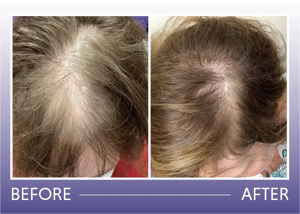 Before and after hair thinning treated with PRP, topical minoxidil, and nutrafol result 