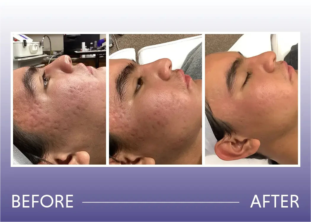 Before and after photos of laser treatment for acne scar and acne microneedling