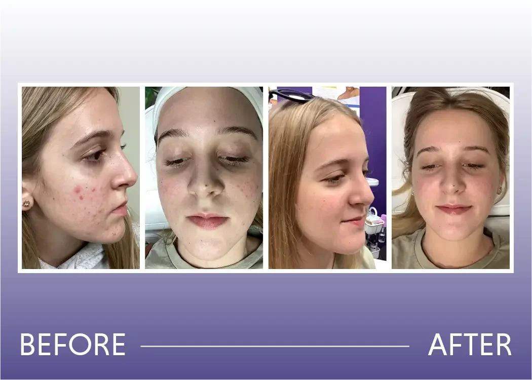 Before and after photos of laser treatment for acne and acne scarring