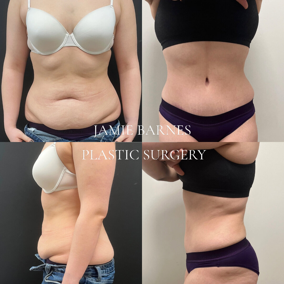 Many thanks to my patient for sharing her photos showing before and 6 months after drain free lipoabdominoplasty. She is only in her early 20s and had lost a lot of weight and was unhappy with the resultant skin overhang. 

She's done a great job of 