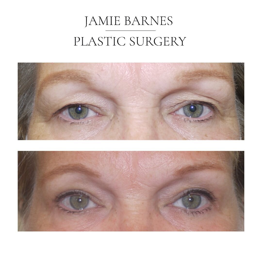 Many thanks to my patient who has shared her photos showing the result of an upper lid blepharoplasty. A quick procedure usually performed awake with local anaesthetic which can reduce heaviness and folds of the upper eyelids and nicely open up the e