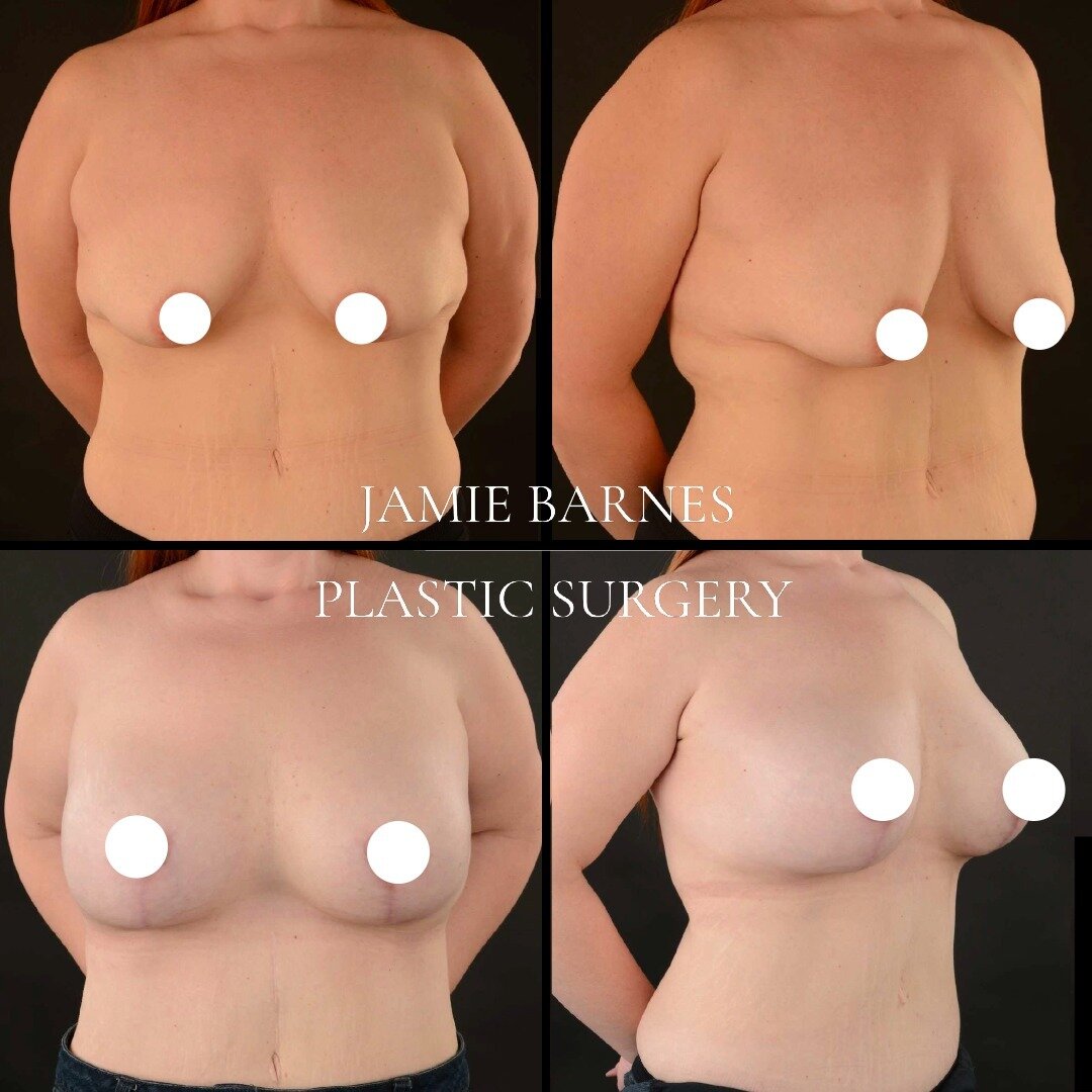 Many thanks to this wonderful patient for sharing her photos showing a single stage tuberous correction using implants and mastopexy.

This lady had lost a large amount of weight and felt very self conscious about her breasts both in and out of cloth