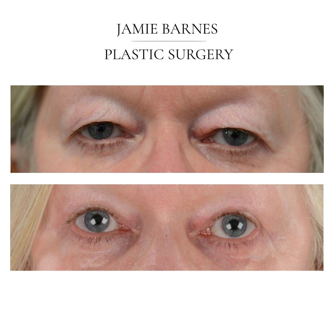 Thanks to my patient who has allowed me to share her photos showing before and 3 months after upper lid blepharoplasty.

This procedure takes under an hour and is generally performed awake under Local Anaesthetic. 

The scar is hidden in the upper ey