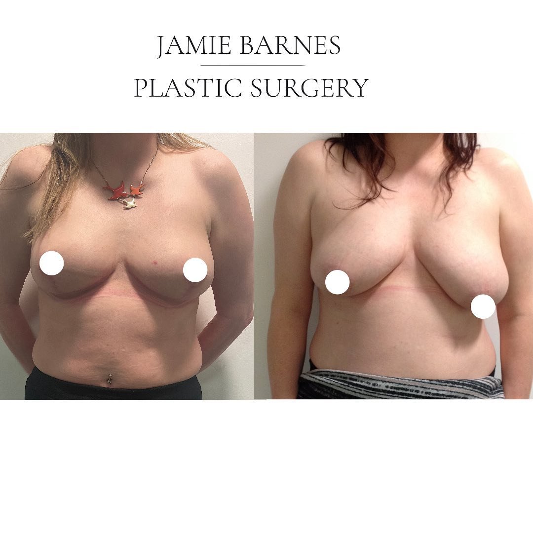 Many thanks to this patient who has agreed to share her pictures. She was concerned with the asymmetry between her breasts as well as the droop and also some fullness to the armpit area which could spill out over bra straps.

We went ahead with a sma