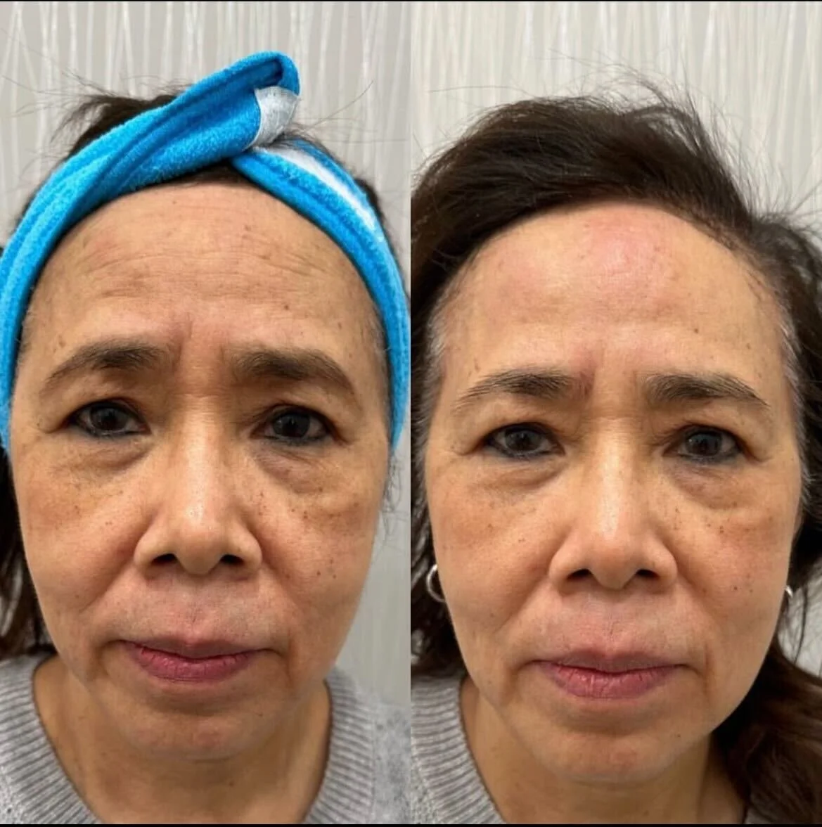 B&A1Facial.jpeg