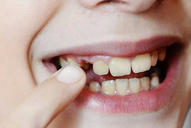 White Bumps on Gums: Harmless or Serious?