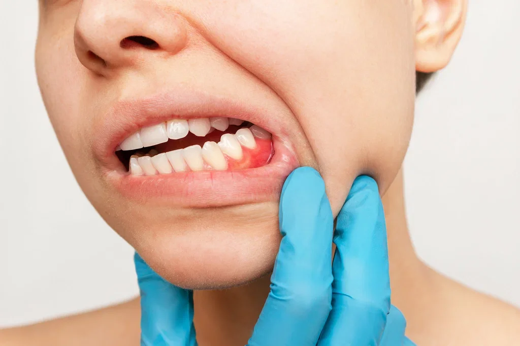 Why Gum Disease Often Goes Unnoticed Until It’s Severe