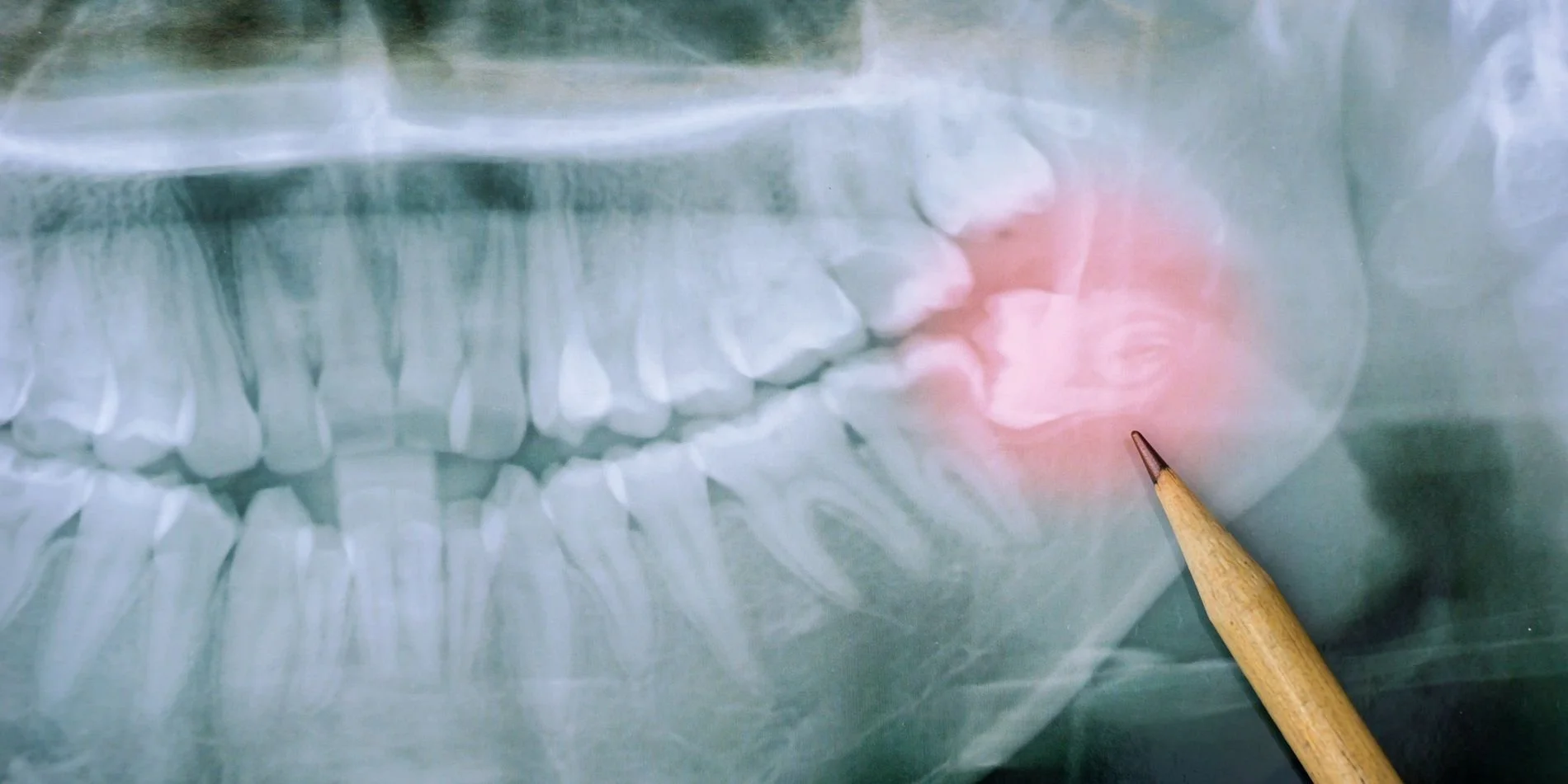 Common Wisdom Teeth Problems and Warning Signs