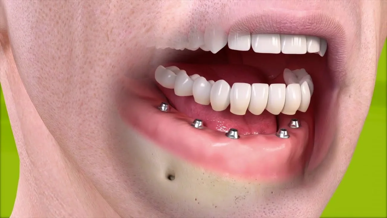 Full Mouth Dental Implants in Westfield, NJ: What to Expect