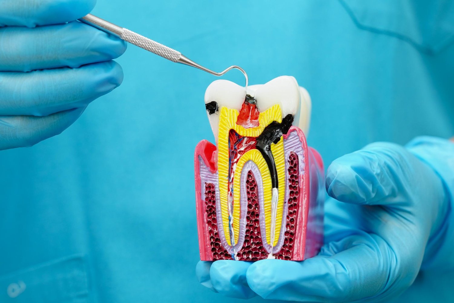 Signs You May Need a Root Canal Treatment