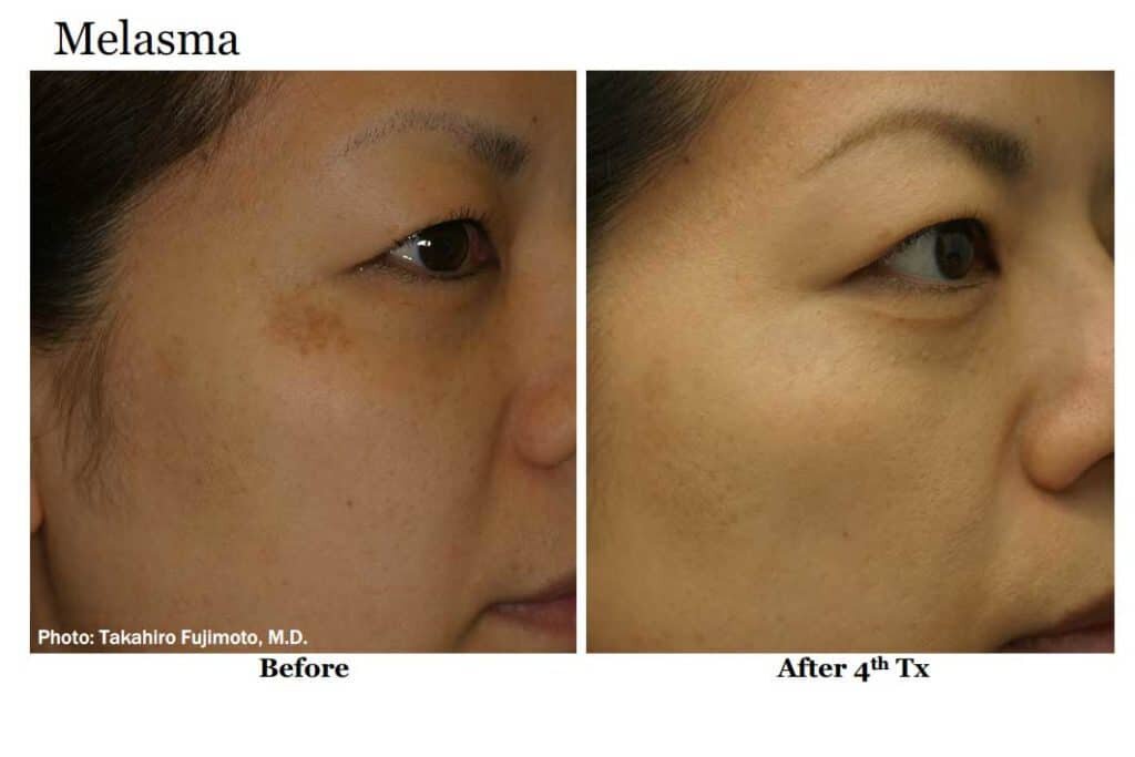 melasma-1024x683.jpg