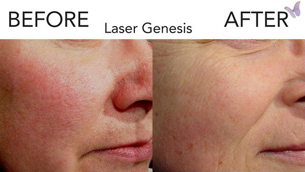 Laser-Gen.jpg