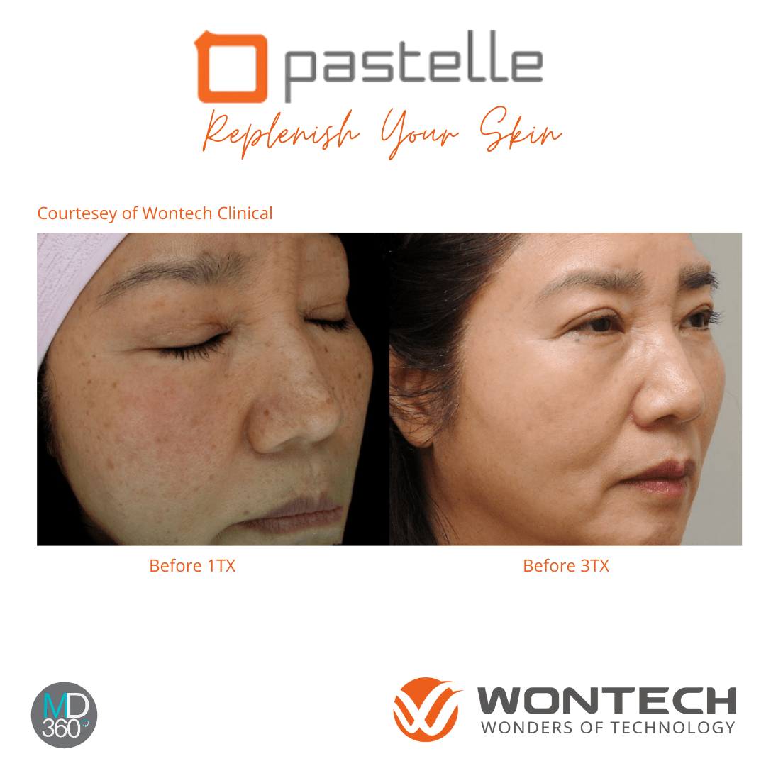 5f5f87b35ca6e668b210d3d1_PIGMENT Skin Type 4 Pastelle BA.png