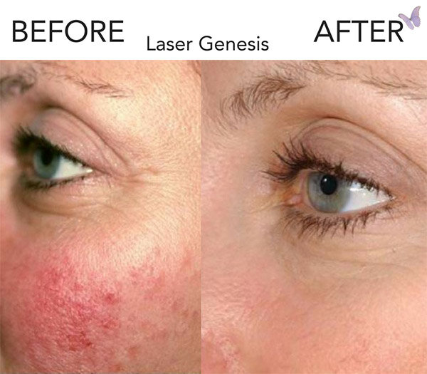 Laser-Gen-BA.jpg