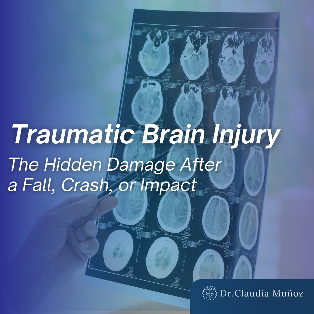 Traumatic Brain Injury: The Hidden Damage After a Fall, Crash, or Impact